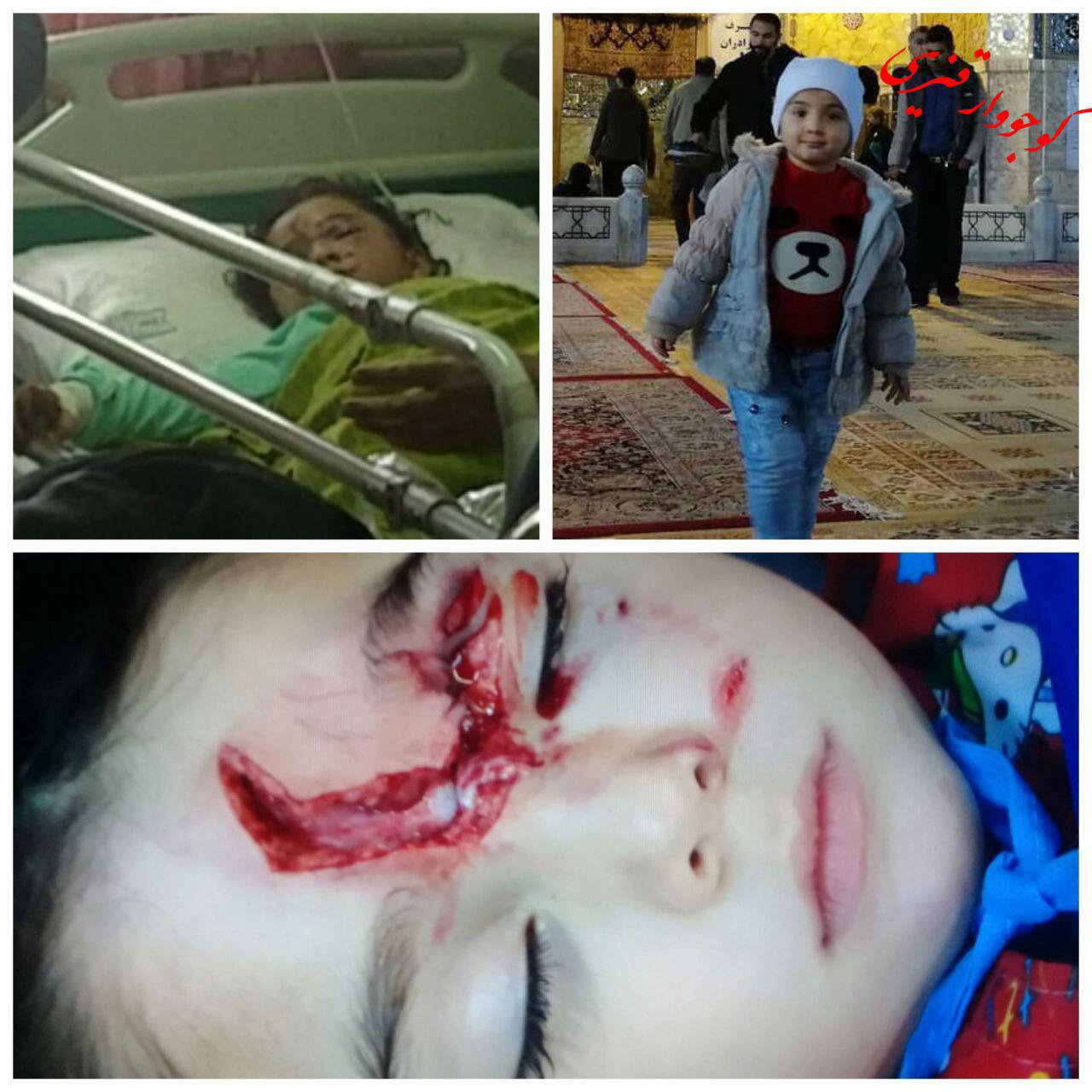 حمله سگ به دختر ۴ ساله در کوجووار/شهرداری: به ما مربوط نیست