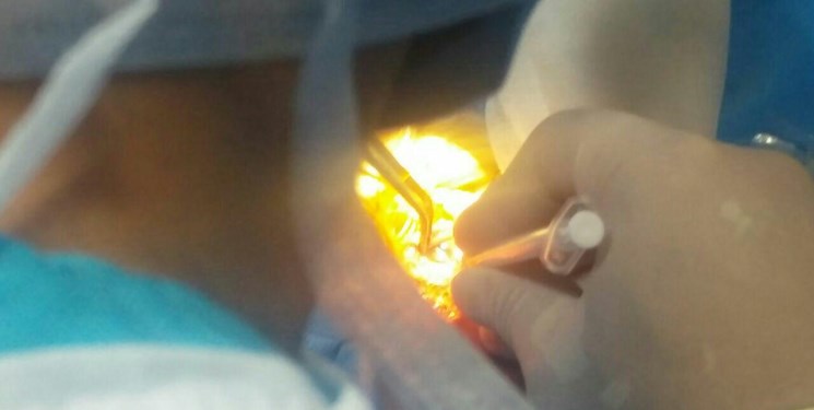 عمل جراحی کاتاراکت چشم خروس در تبریز